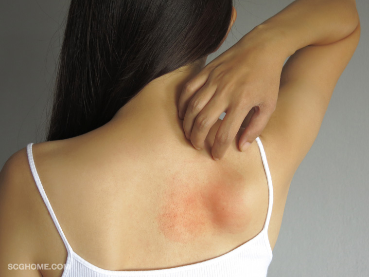 ลมพิษ ผื่นขึ้น